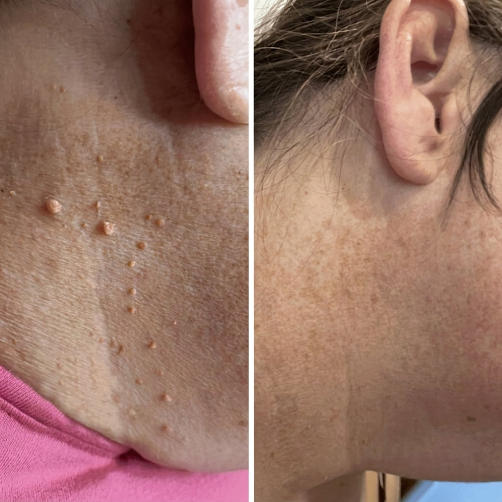 Removedor Indoloro de Fibromas