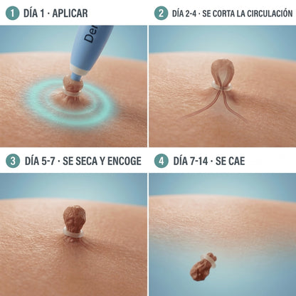 Removedor Indoloro de Fibromas